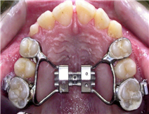 Palatal Expander