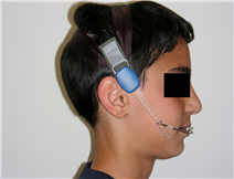 Orthodontic Headgear