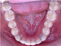 Retainers