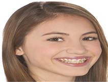 Orthodontic treatment for children