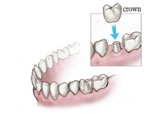 Dental crowns