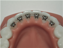 Lingual Braces