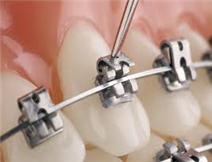 Self-ligating Braces