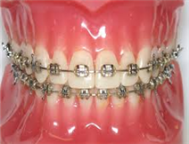 Metal Braces